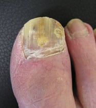 Fungal nail treatment Penrith