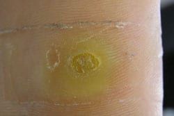 Plantar Warts