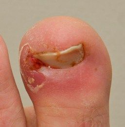 Ingrown toenails – pain free treatment