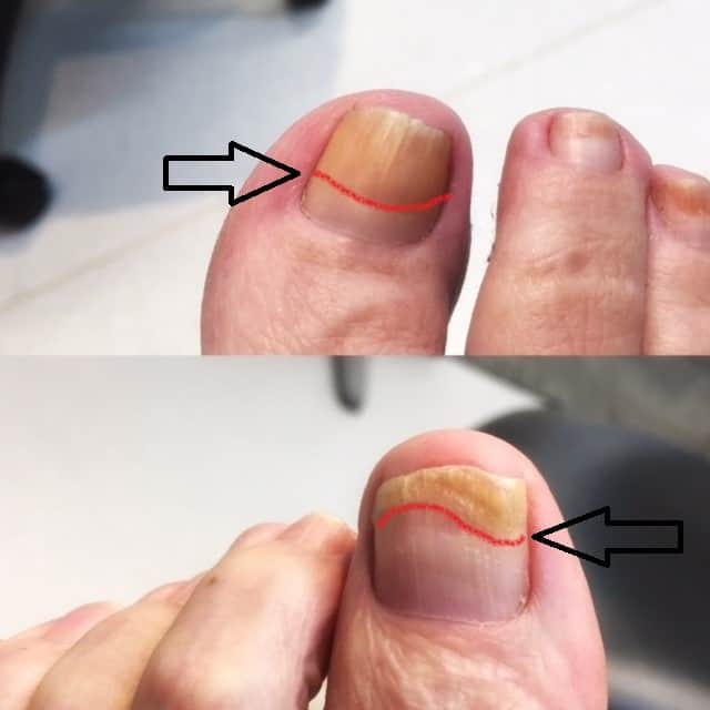 Fungal nail treatment Penrith