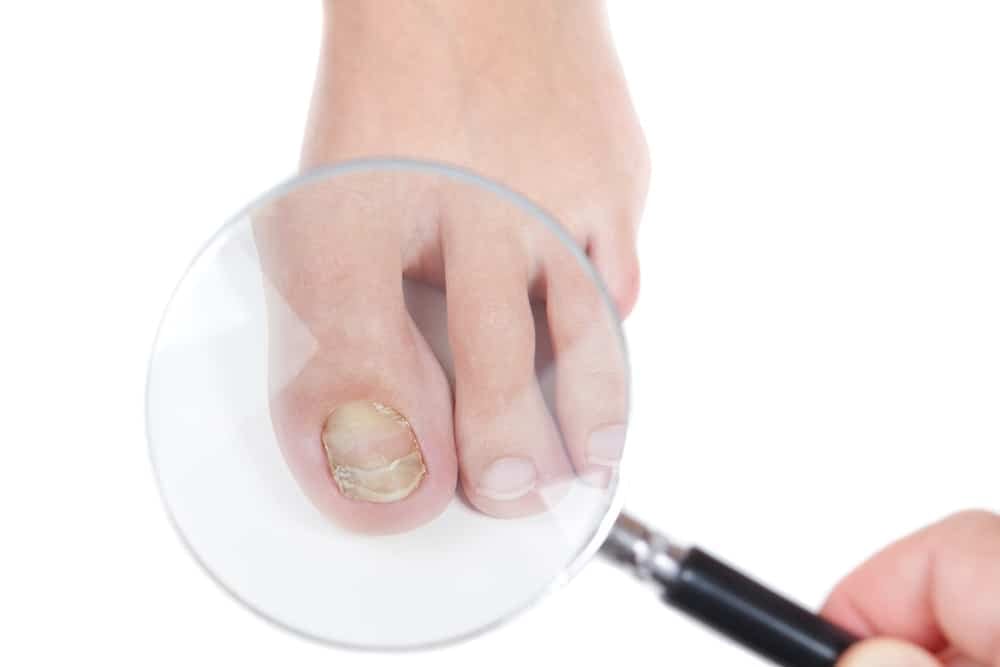 fungal nail infection