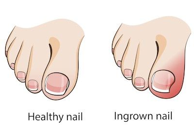 5 hacks to keep ingrown toenails at bay