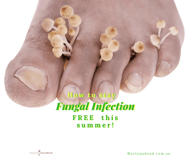 5 tips for fungus-free feet this summer