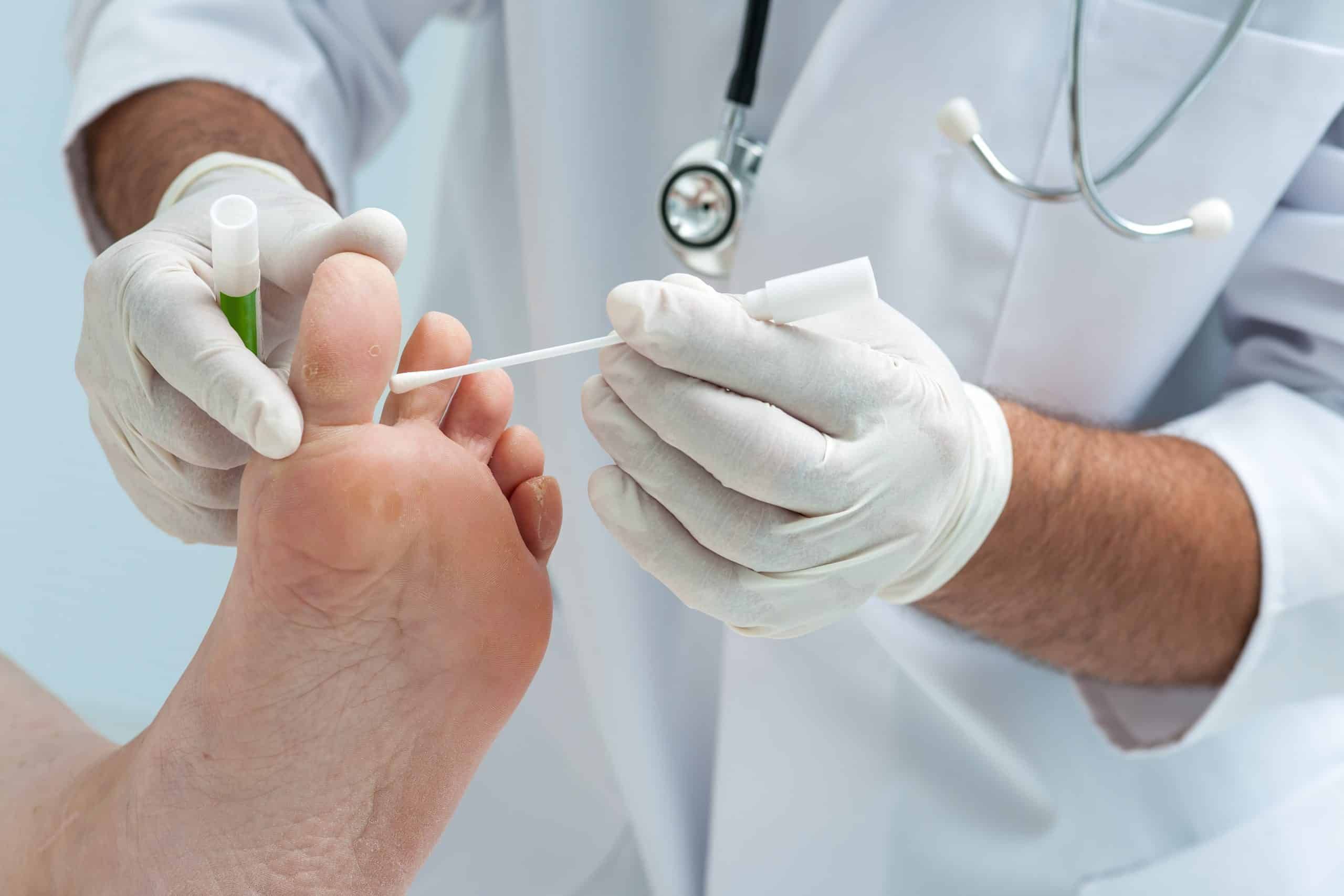 Worried you have a Fungal Nail Infection? See your GP or Podiatrist for a diagnosis.