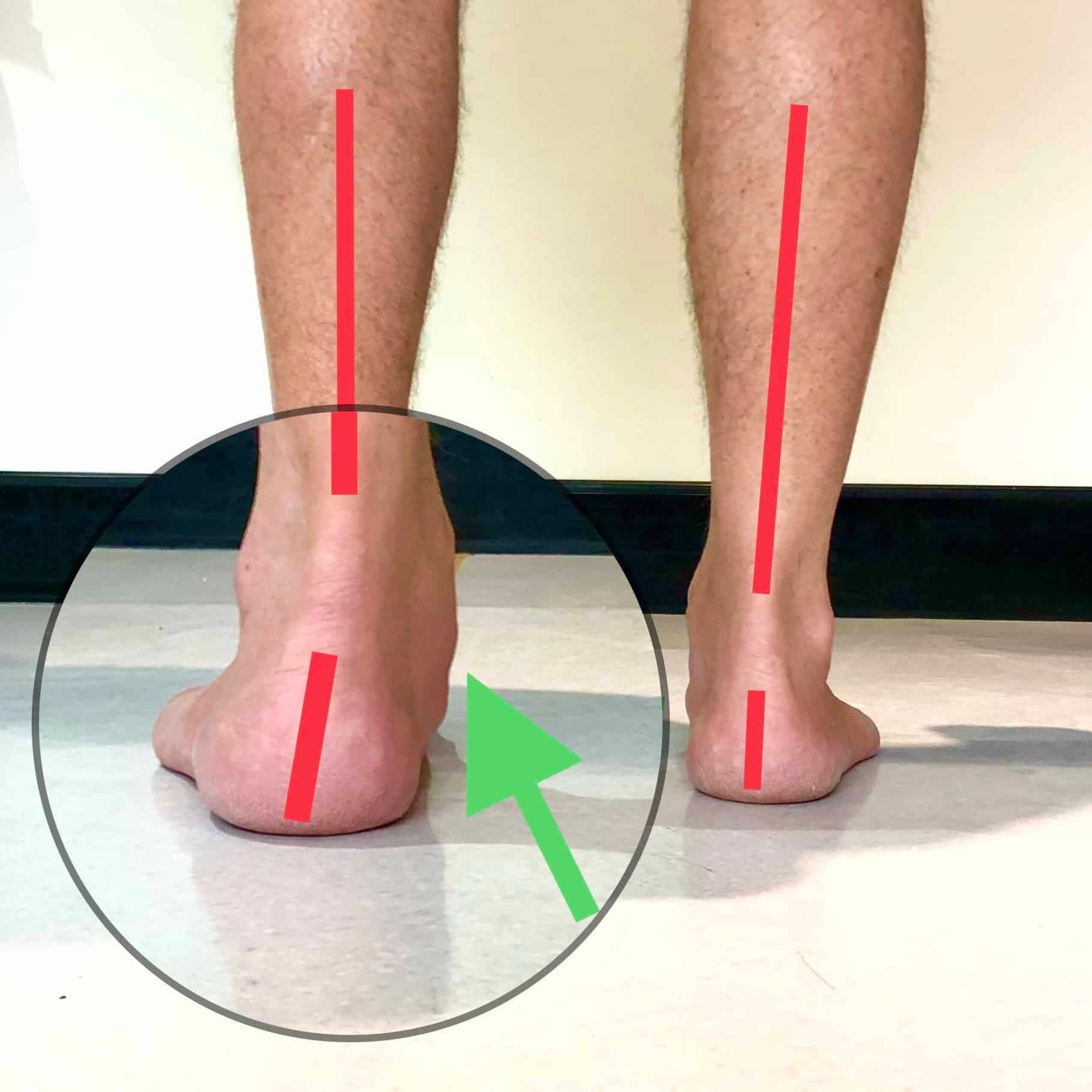 Fallen Arches or Flat Feet