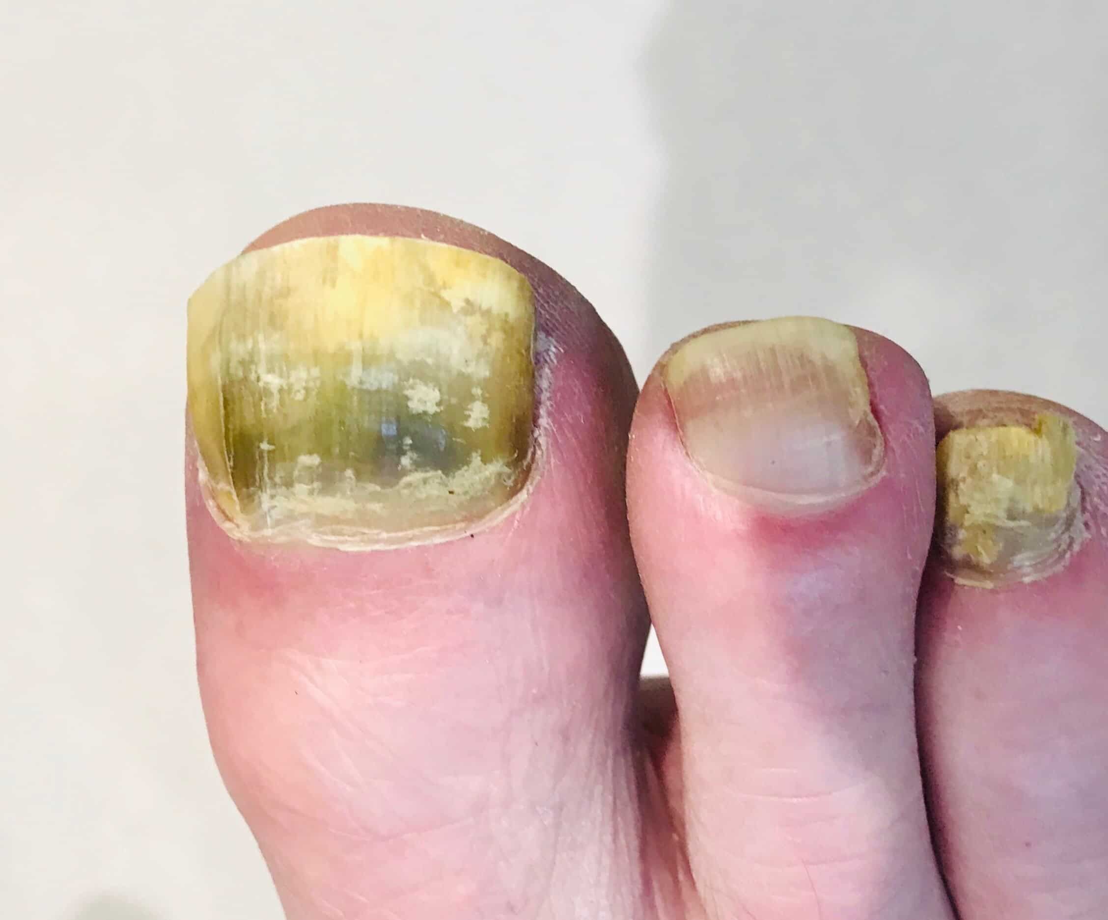 Fungal Nail Infection - 6 Questions Answered