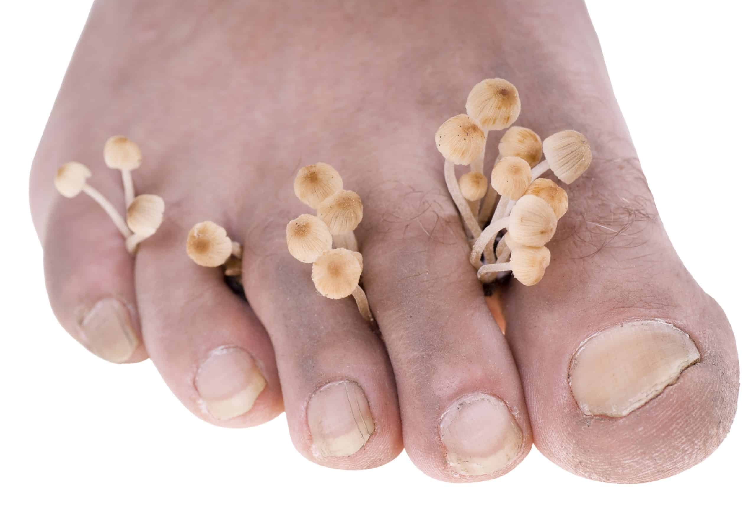 Fungal Nail Infections - 5 questions to ask