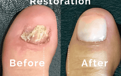 Fungal Nail Restoration