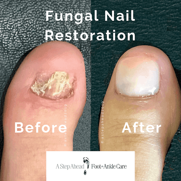 Fungal Nail Restoration