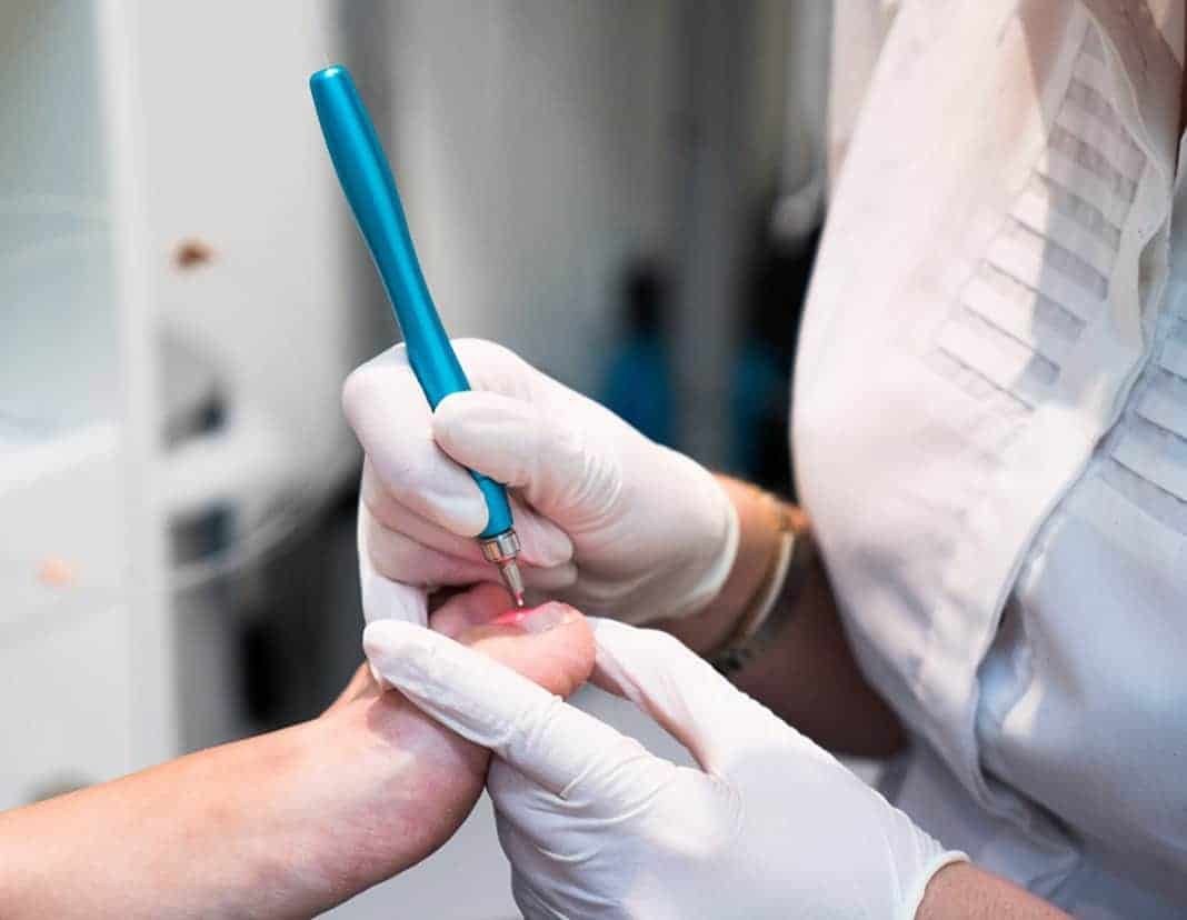 Fungal-Nail-YOURE-WORRIED-ABOUT-FUNGAL-NAIL Western Sydney Penrith Podiatry