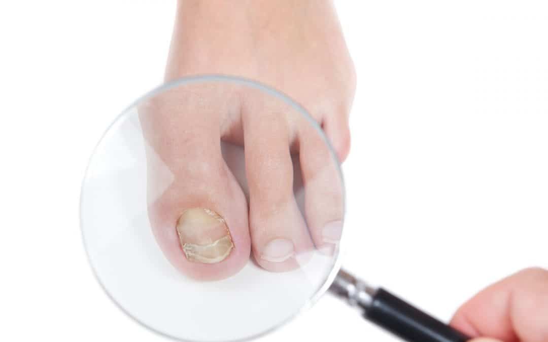 Fungal nail with “false negative” results?