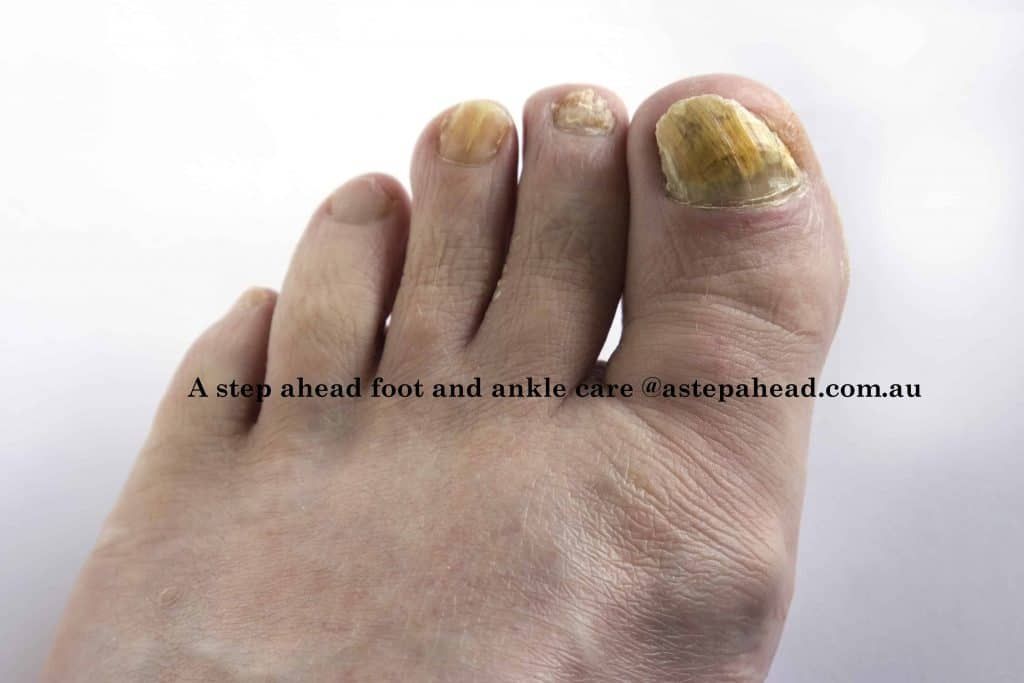 Fungal toenails GONE FAST! - 1