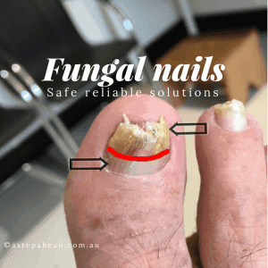 How Tanya beat unsightly Nail Fungus - 4