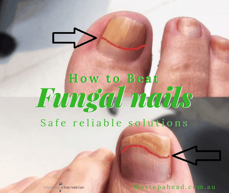 How Tanya beat unsightly Nail Fungus