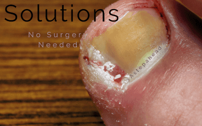 Ingrown Toenails – Need Solutions?