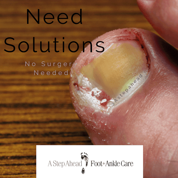 Ingrown Toenails – Need Solutions?