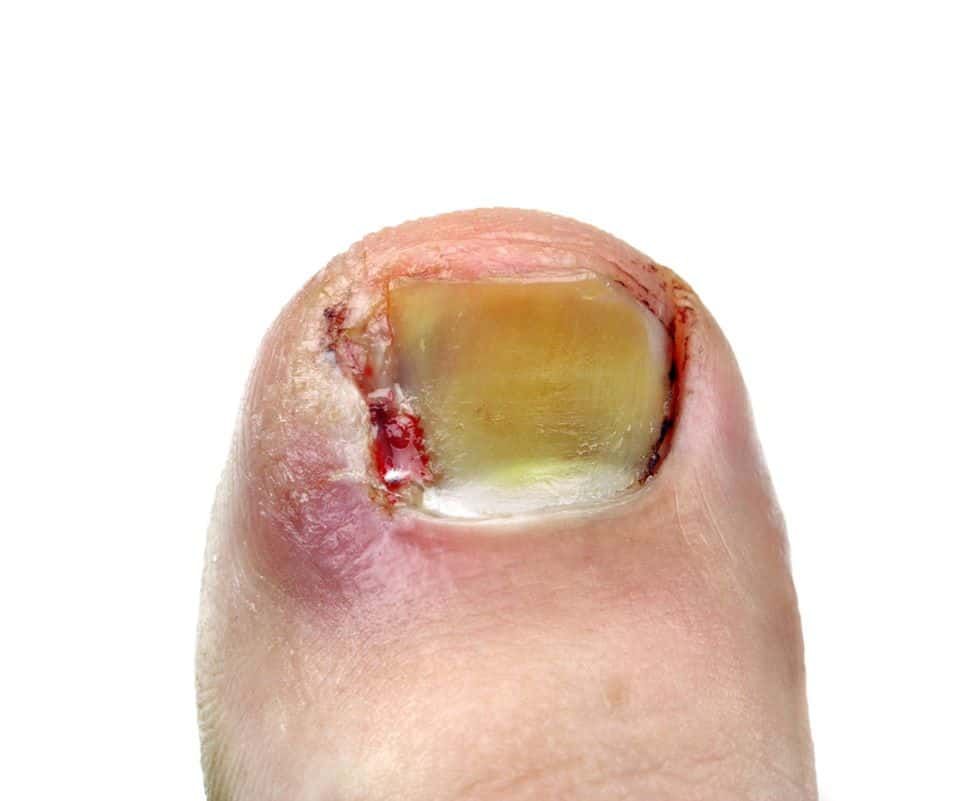 Ingrown toenails Ouchi Mumma these can hurt
