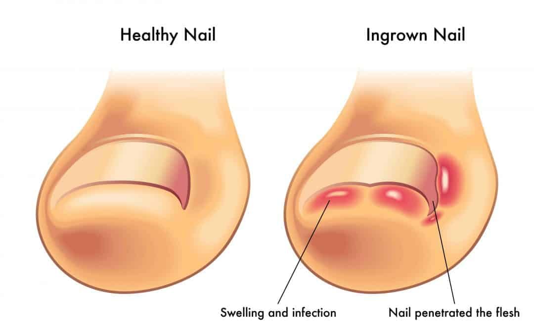 Ingrown Toenails Do I Need Surgery?