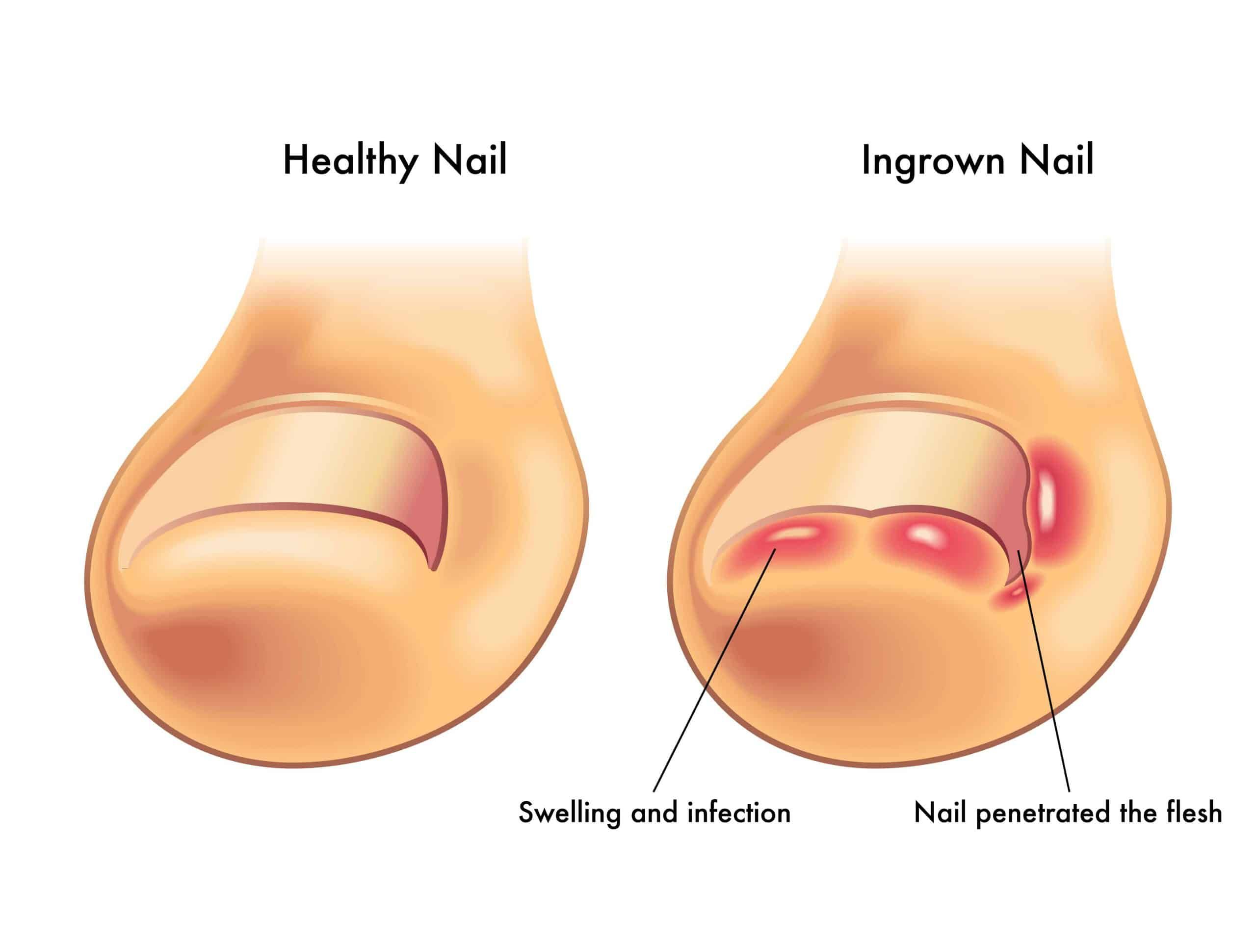 Ingrown Toenail-YOU HAVE AN INGROWN TOENAIL
