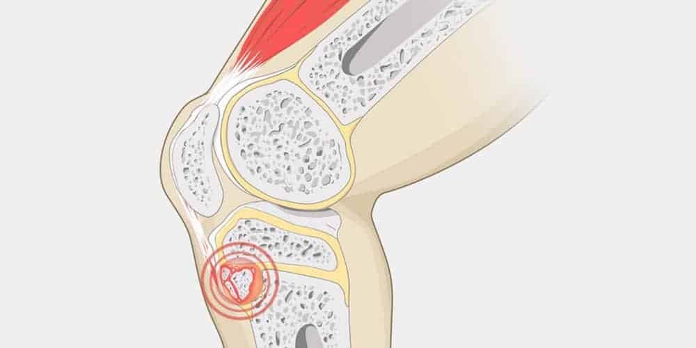Knee pain in kids - 2