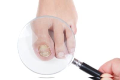 Nailing fungus with laser technology