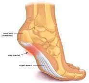 Not ALL heel pain is plantar fasciitis