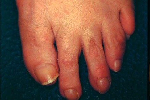 The GAP between my toes has a name; Plantar plate disruption