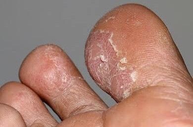 Tinea - flaky skin blisters-mild