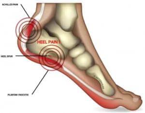 Top 6 reason your heel pain isn't getting better - UPDATED - 1