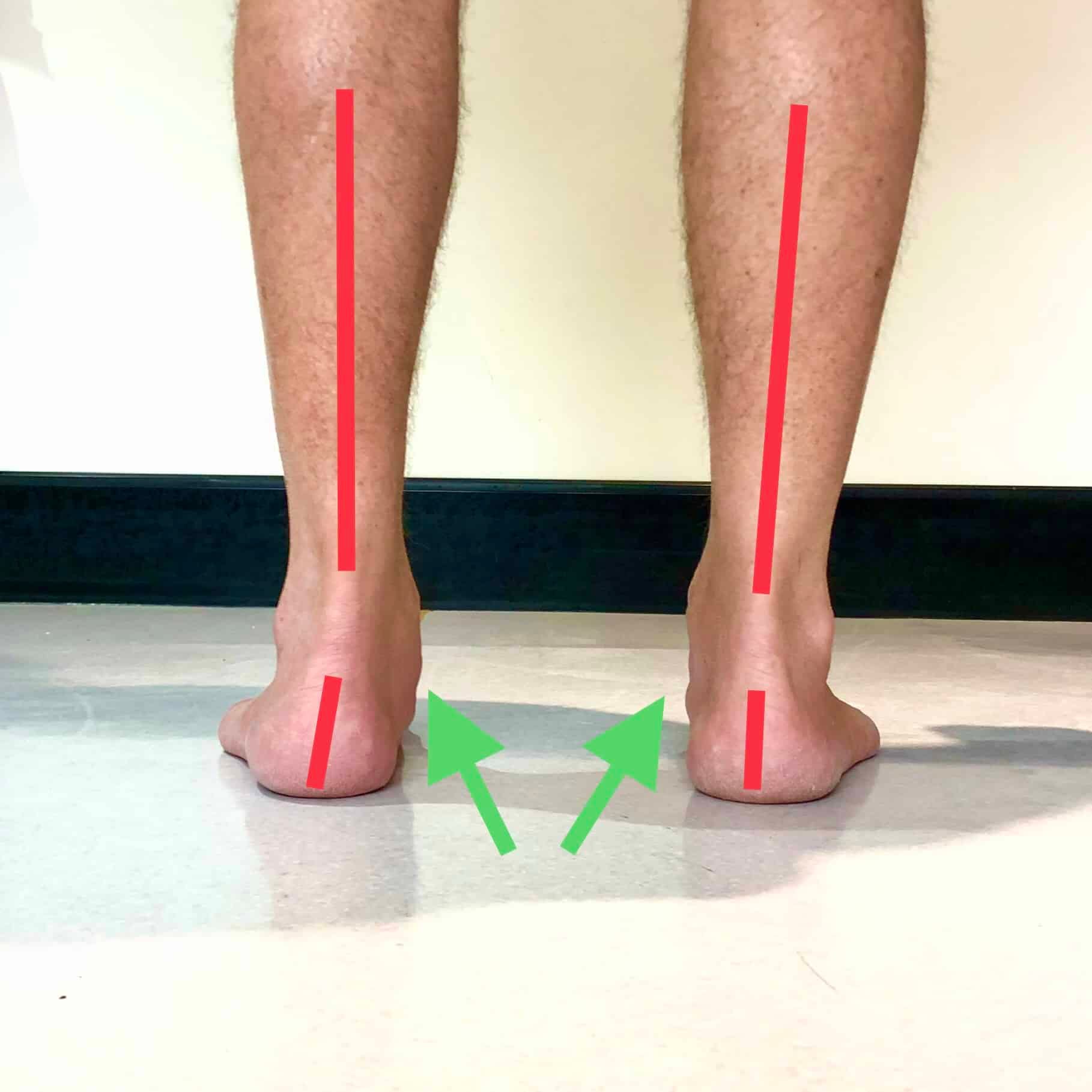 What do Fallen Arches or Flat Feet look like?